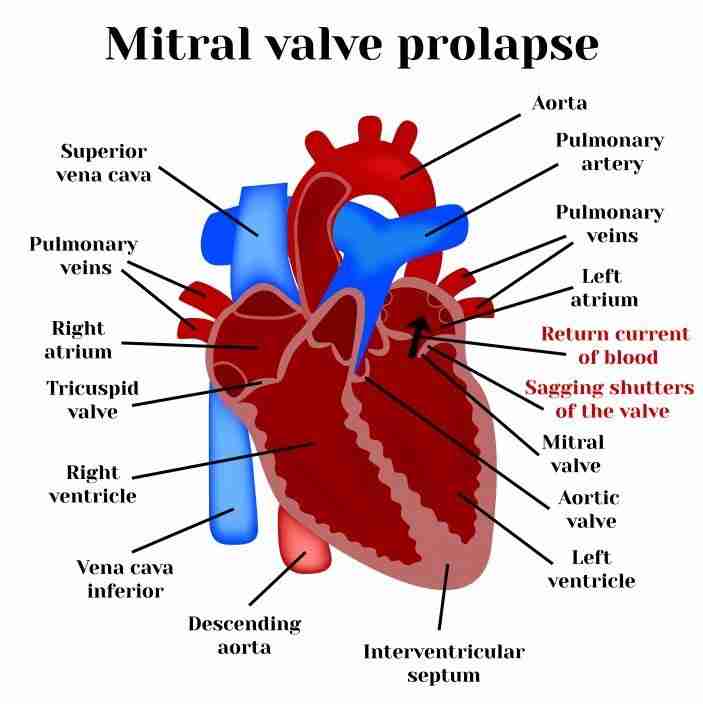 Symptoms of Mitral Regurgitation